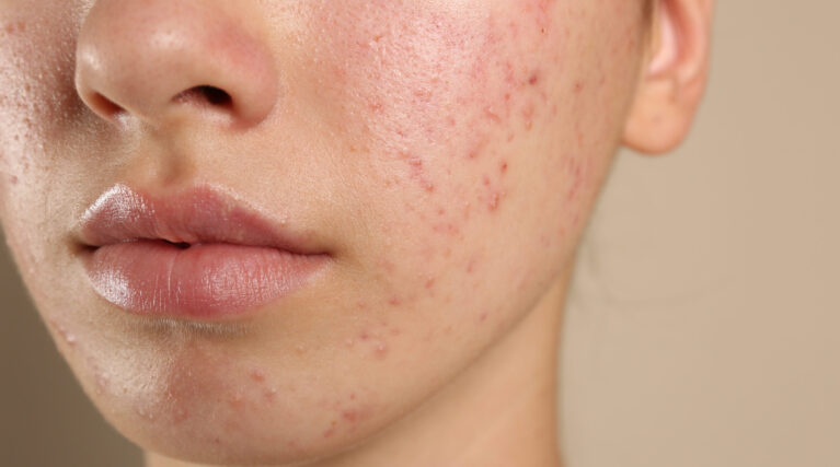 Teenage girl with acne problem on beige background, closeup Teenage girl with acne problem on beige background, closeup