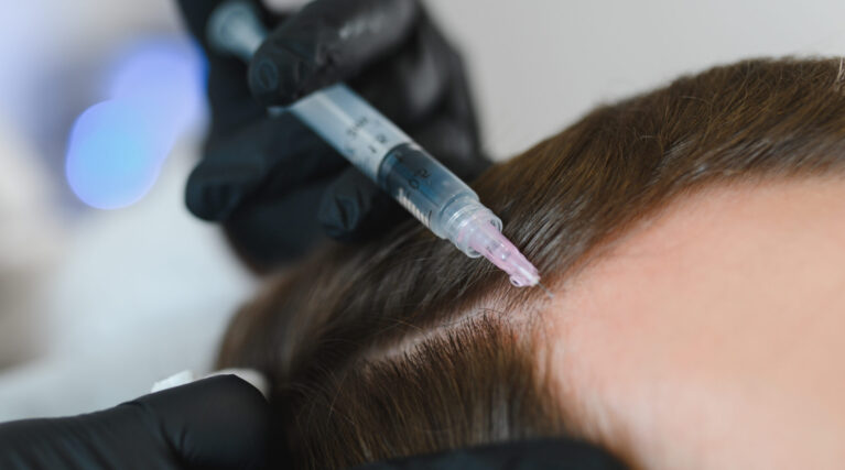 Man getting hair treatment at beauty salon, having mesotherapy session. Female therapist hands in protective gloves making injection with syringe Man getting hair treatment at beauty salon, having mesotherapy session. Female therapist hands in protective gloves making injection with syringe.