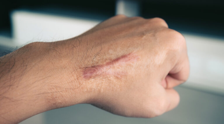 Scar on human skin keloid on hand. Scar on human skin keloid on hand.