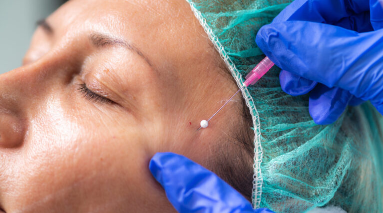 Mesotherapy Facelifting Procedure. 3D Meso Threads. 3D Meso Threads for Face Lifting and Contouring. Aesthetic Medicine Concept.