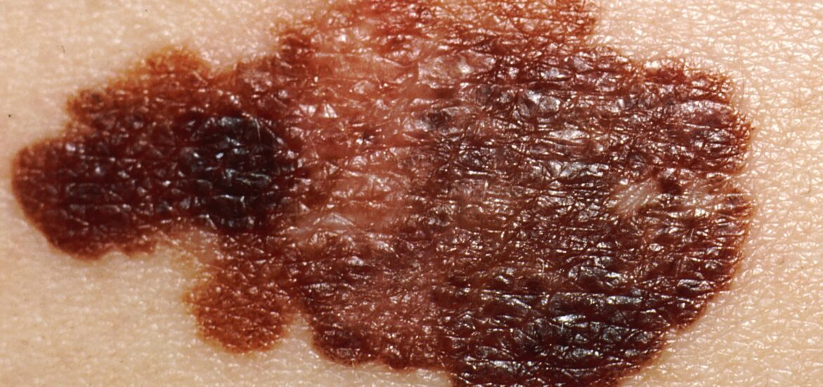Melanoma Melanoma
