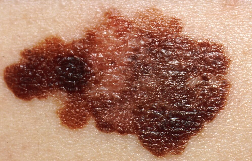 Melanoma Melanoma