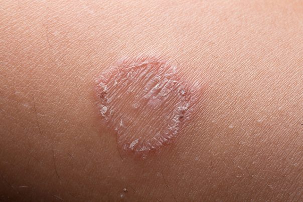 Ringworm-604x403-1 (1) Ringworm-604x403-1 (1)