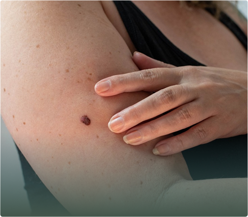 a-guide-to-skin-cancer-symptoms-prevention-and-treatments-featured a-guide-to-skin-cancer-symptoms-prevention-and-treatments-featured