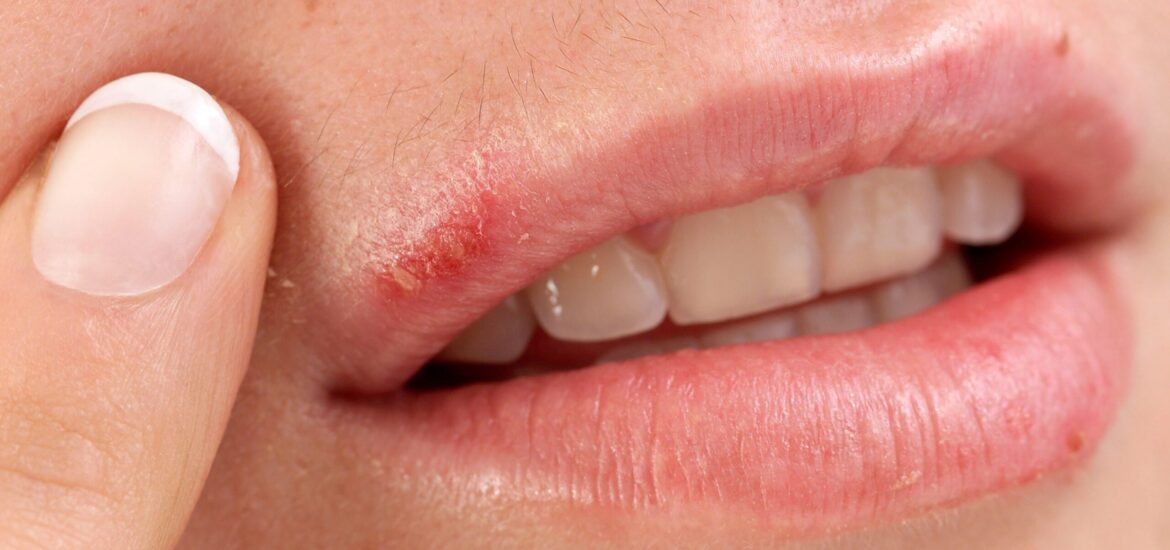 cold-sores-3863fb cold-sores-3863fb