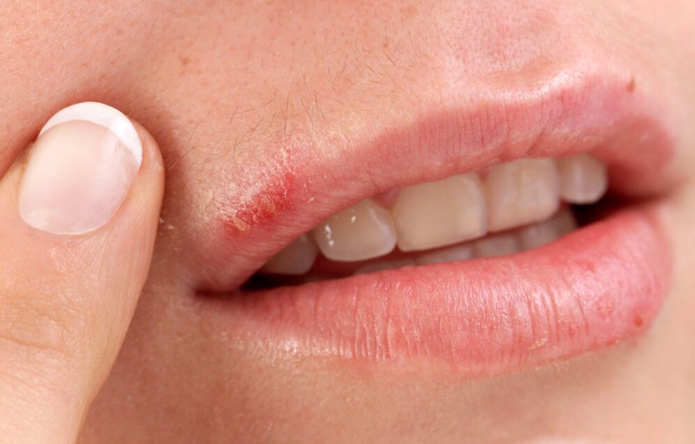 cold-sores-3863fb cold-sores-3863fb