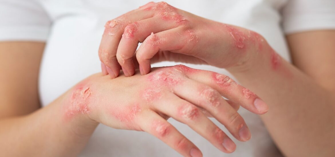psoriasi-kai-ekzema psoriasi-kai-ekzema