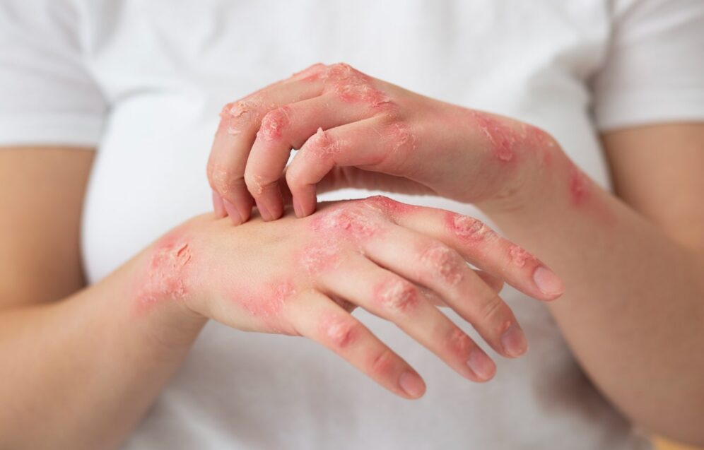 psoriasi-kai-ekzema psoriasi-kai-ekzema