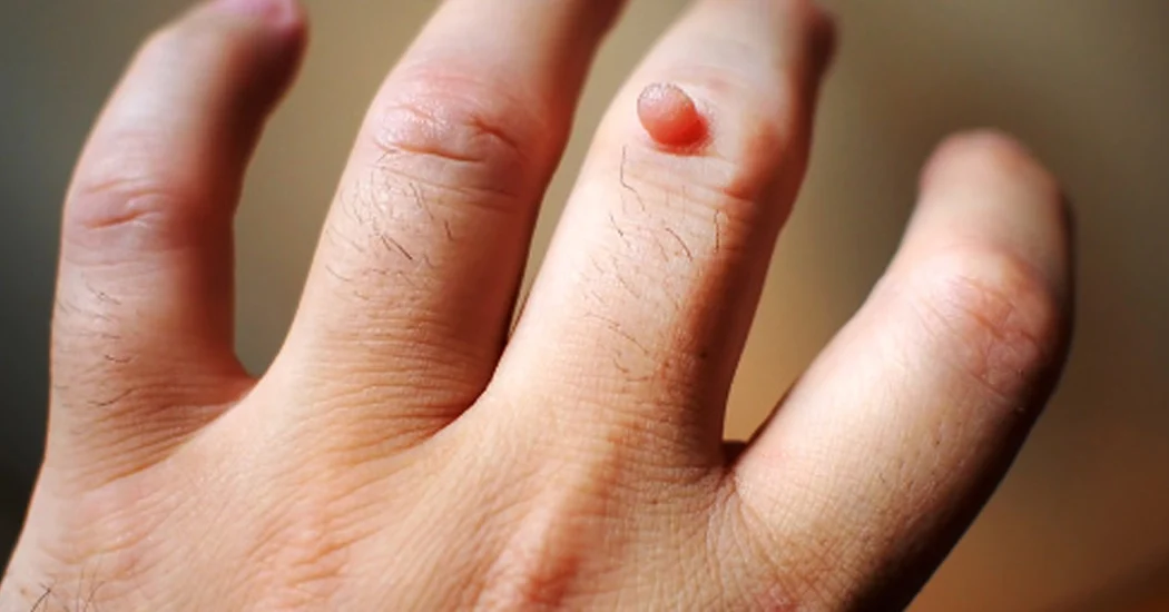 warts-the-skin-docs warts-the-skin-docs