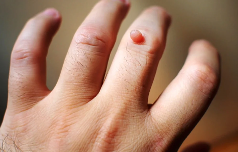 warts-the-skin-docs warts-the-skin-docs