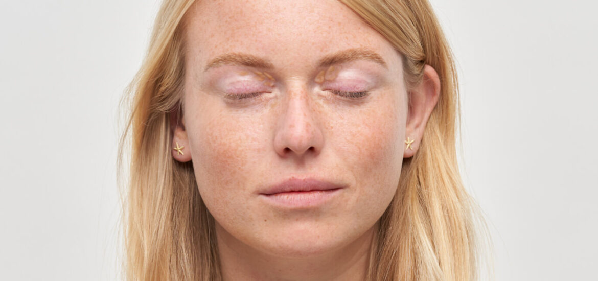 xanthelasma_intro_d xanthelasma_intro_d