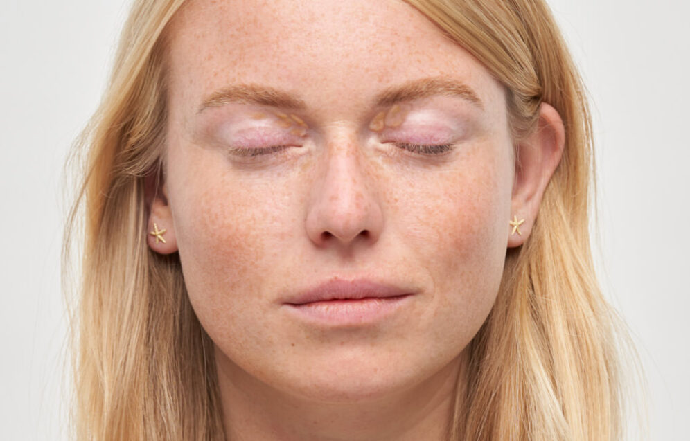 xanthelasma_intro_d xanthelasma_intro_d