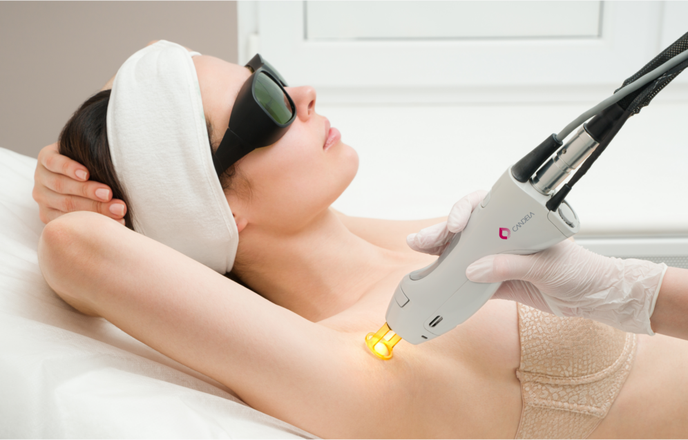Candela-GentleMax-Pro-Laser-Treatments-procedure