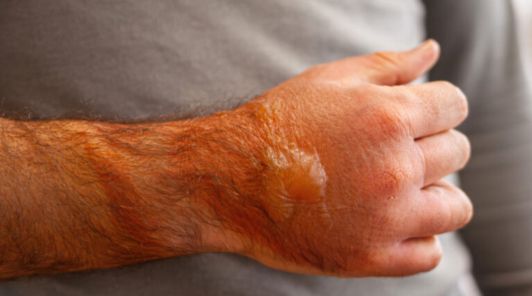 Construction worker showing a large second degree burn with blisters on his arm