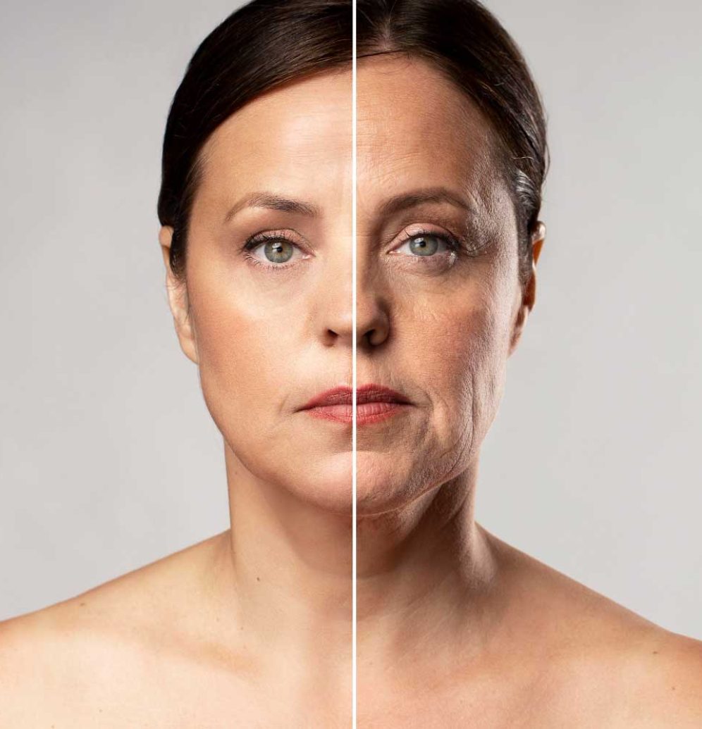 Carboxytherapy-before-after-opt