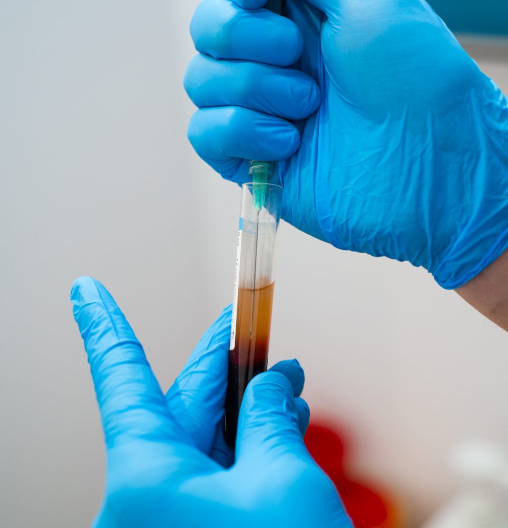 Centrifuged blood sample showing separated plasma prepared for PRP therapy