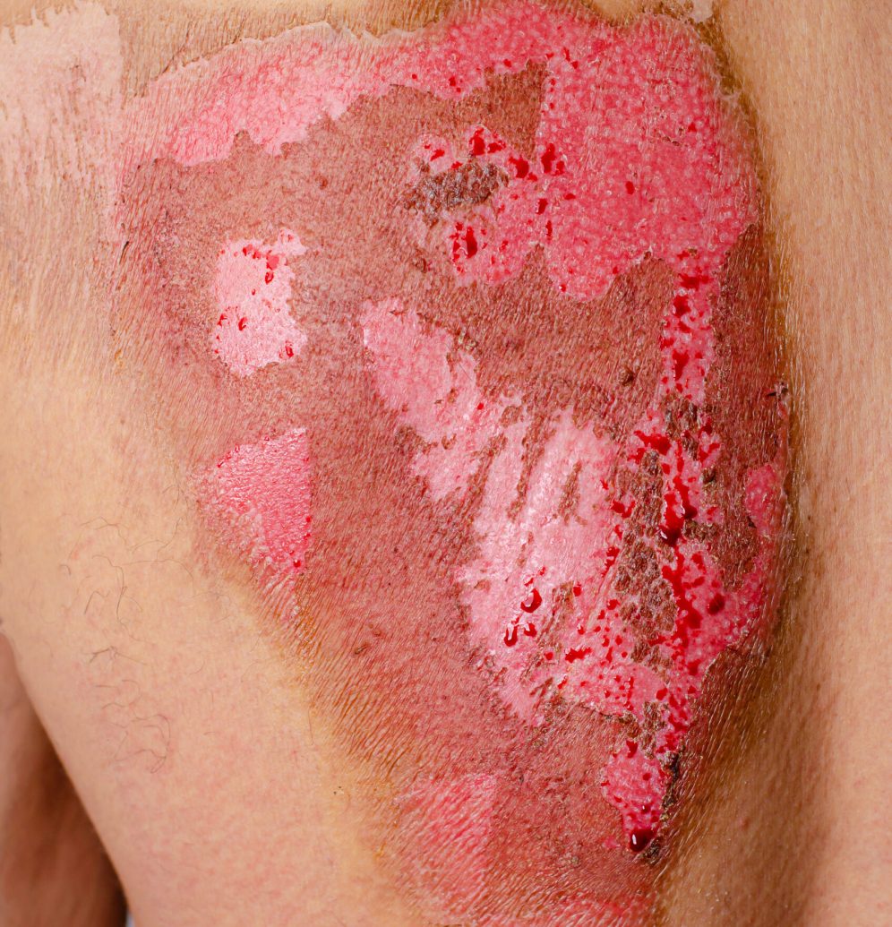 Second-degree burns on male back caused by heat. Medical concept.