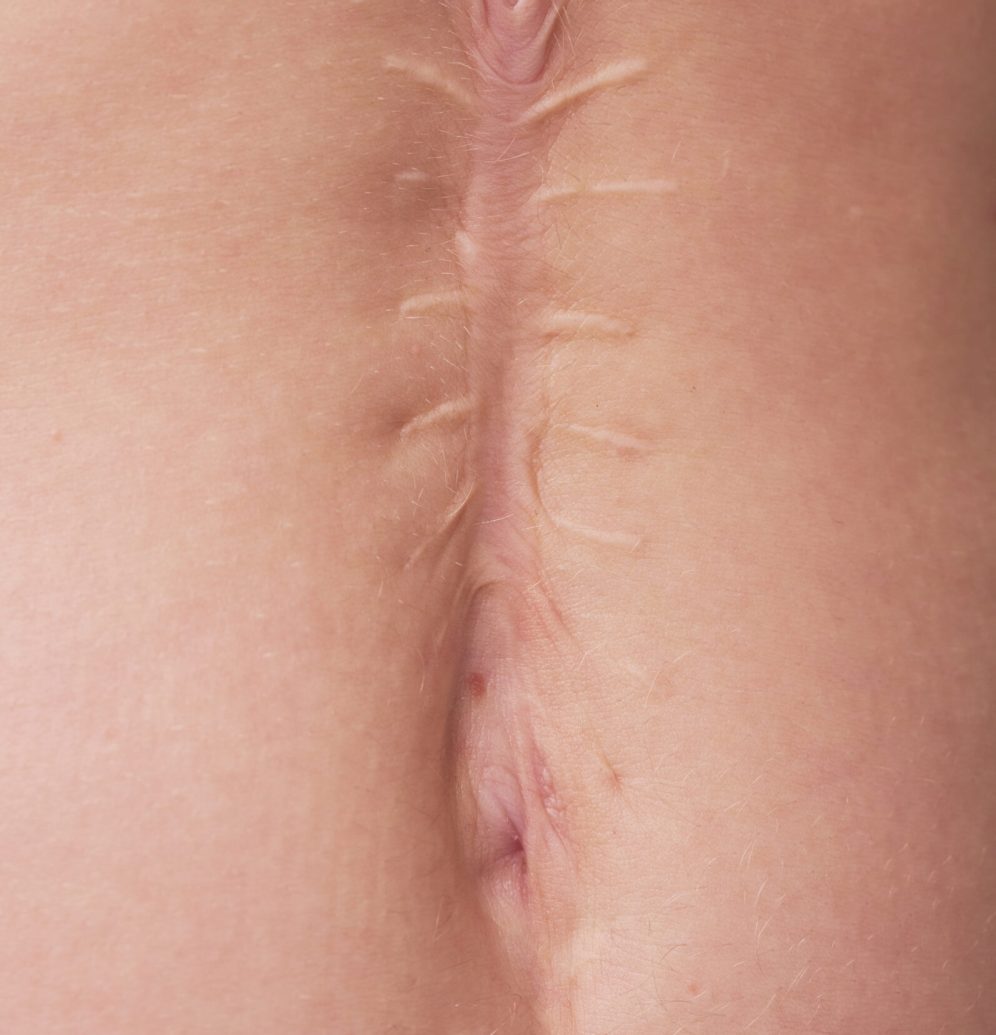 Close-up of surgical scar on female body