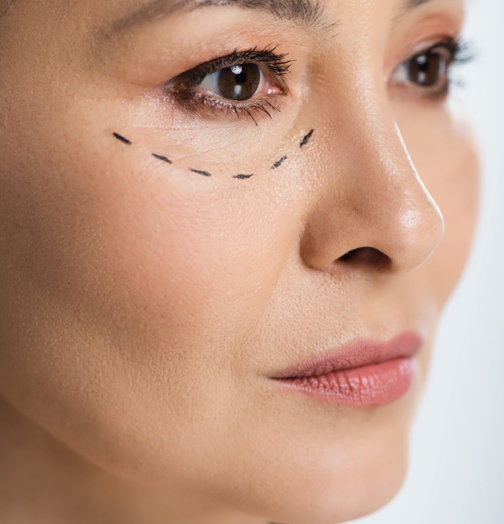 asian woman with plastic surgery lines on face isolated on grey