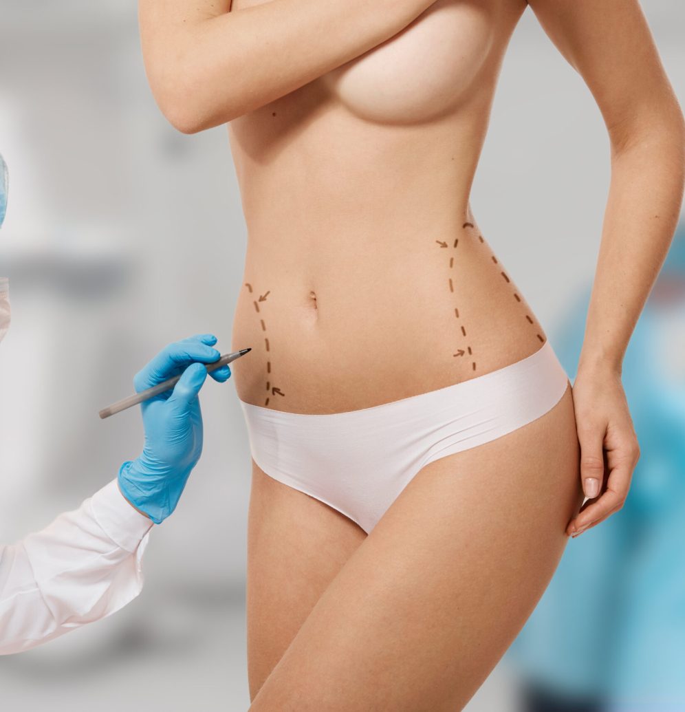 Plastic surgery doctor draw line on patient breast augmentation implant. Woman belly marked out for cosmetic surgery in surgery room interior