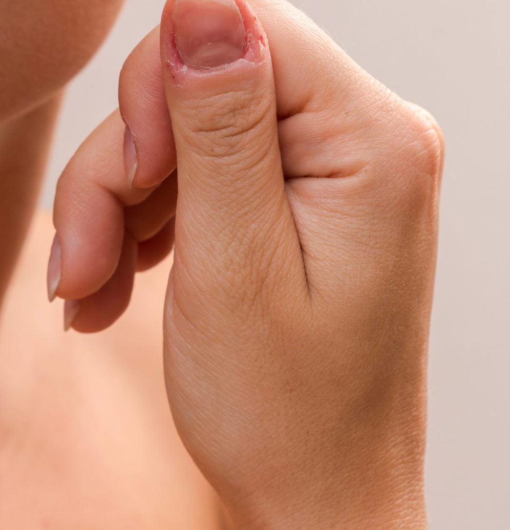 Close up of injured female finger after biting nails