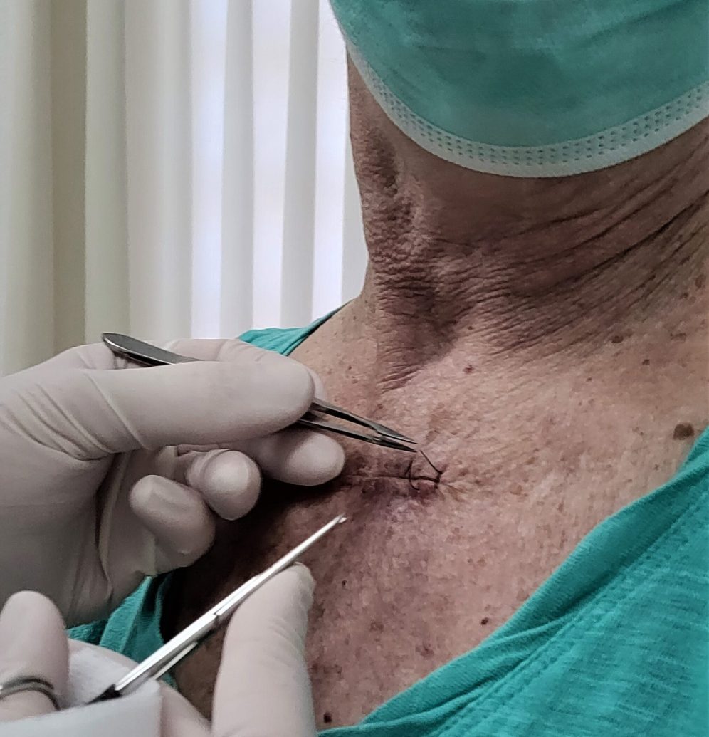 suture-removal-by-medical-professional-close-up-2026-07-15-21-34-12-utc
