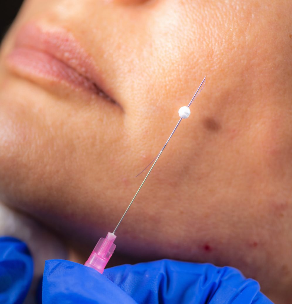 Doctor doing 3D Meso Thread Face Lifting Treatment on Woman’s Face. Mesotherapy in Aesthetic Medicine