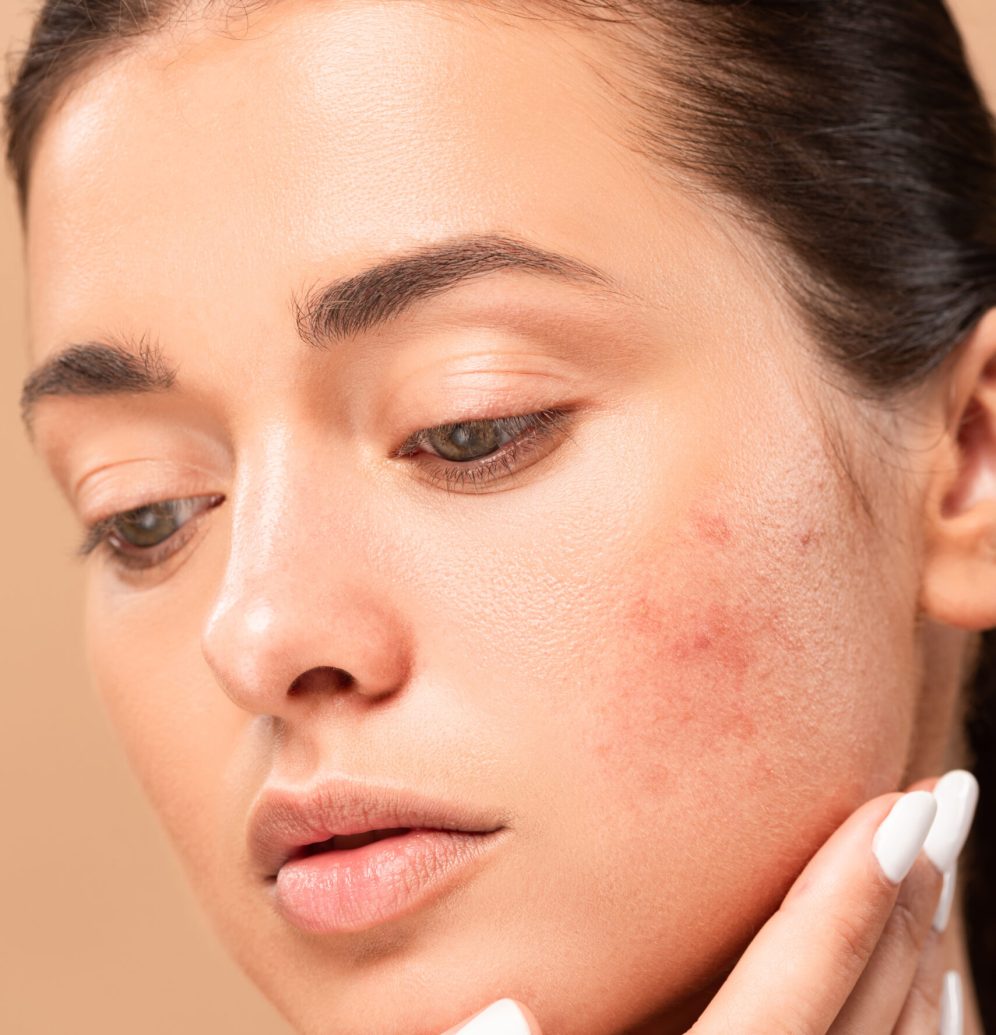 young woman touching face with problem skin isolated on beige